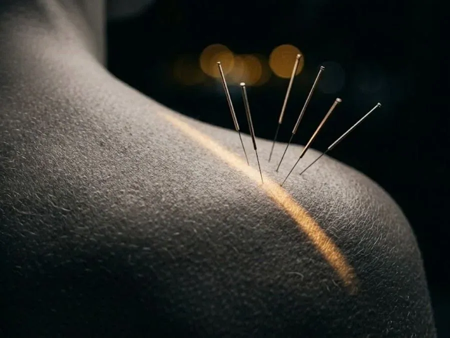 Acupuncture Needles Monaco